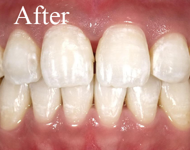 SHINE DENTAL CLINIC のSMILE SHINE WHITENING 術後 ３回目　さらに白く輝く歯に！