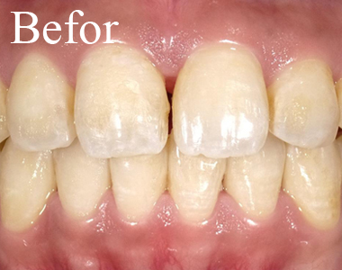 SHINE DENTAL CLINIC のSMILE SHINE WHITENINGの術前　黄色味のある前歯