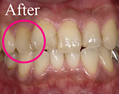 SHINE DENTAL CLINIC のSMILE SHINE WHITENINGの術後　本来の歯の白さに！