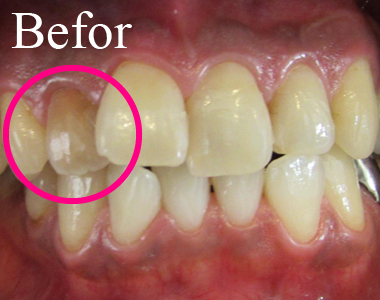 SHINE DENTAL CLINIC のSMILE SHINE WHITENINGの術前　神経処置後の変色に対する漂白