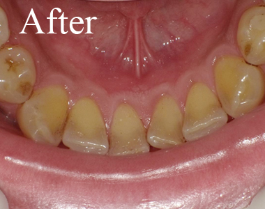 SHINE DENTAL CLINIC のクリーニング術後