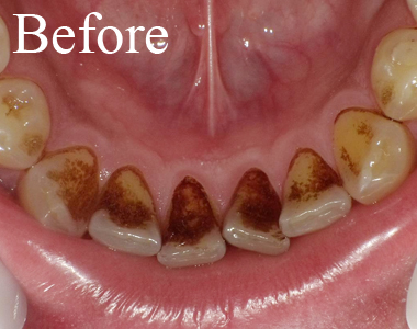 SHINE DENTAL CLINIC のクリーニング術前